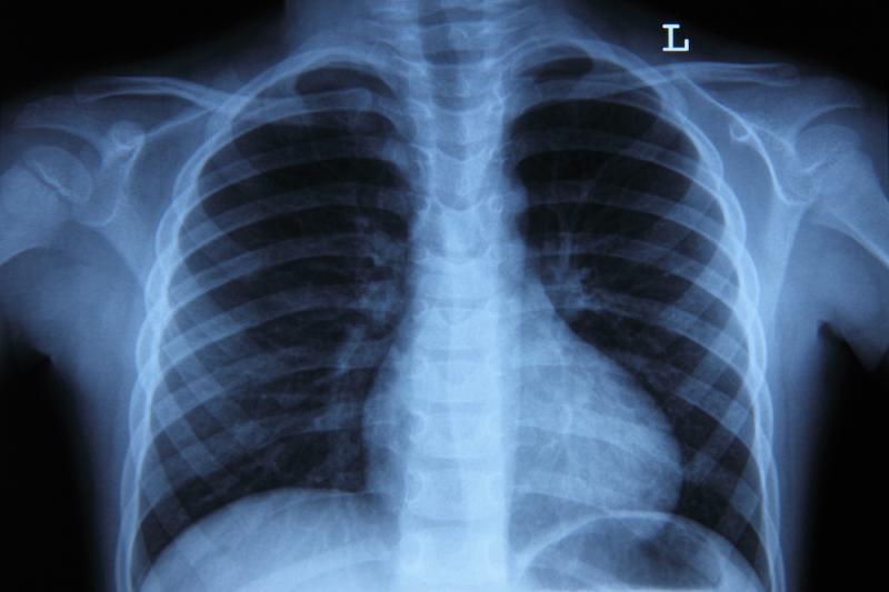 Lung xray