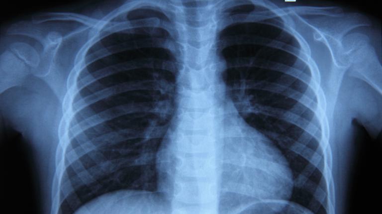 How historical disease tuberculosis spreads & who's at risk